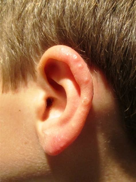 My 8 Year Old Son Has Multiple Little Raised Bumps On His Upper Ears