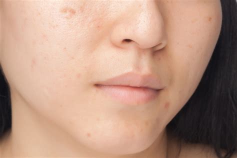 9 Helpful Tips To Help You Cover Up Those Bad Acne Scars
