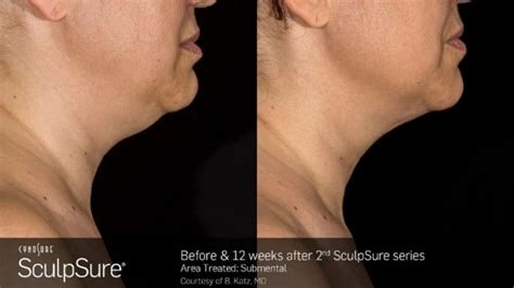Sculpsure Before And After Photos Real Patient Results New Beauty
