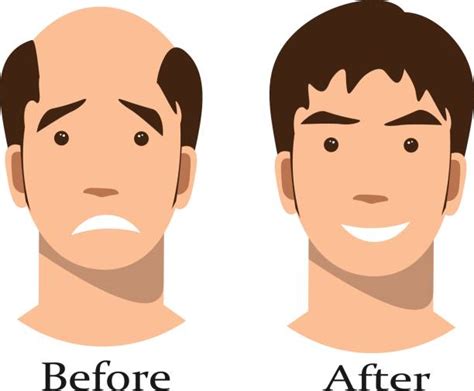 Man With Thinning Hair Illustrations Royalty Free Vector Graphics And Clip Art Istock