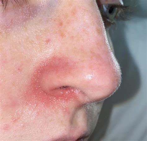 Red Super Flakey Dry Skin Around Nose Seen Two Doctors And First