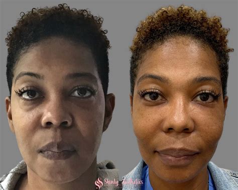 Under Eye Fillers Before And After Results At Skinly