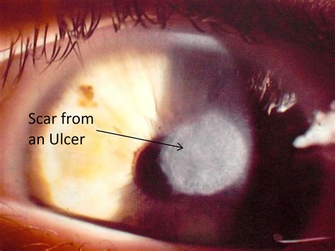 Conjunctivitis And Corneal Ulcer Treatments In Elmhurst Il