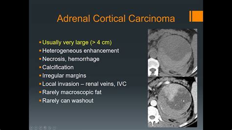 Imaging Of Adrenal Gland Youtube