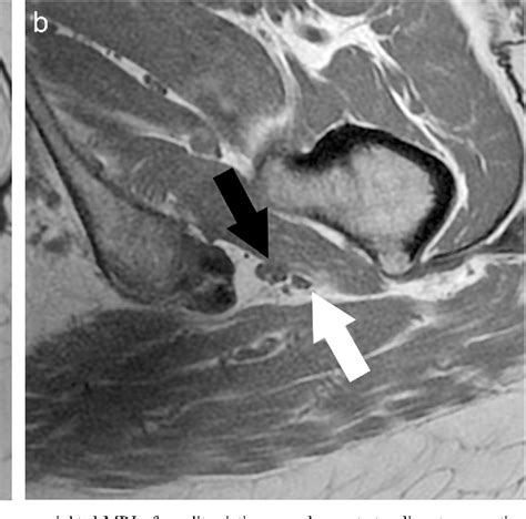 Detection And Prevalence Of Variant Sciatic Nerve Anatomy In Relation