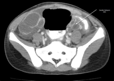 Ct Scan Of The Abdomen And Pelvis With Intravenous And Open I