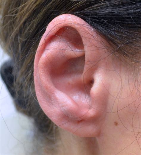 Before And After Photos Mohs Surgery Ear 3 Nyc
