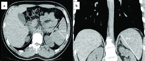 The Method For Calculating Spleen Volume On Ct First Of All In Axial