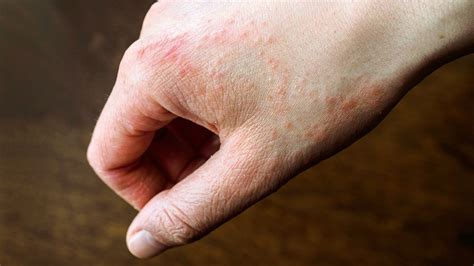What Causes A Rash On Your Hands And Feet