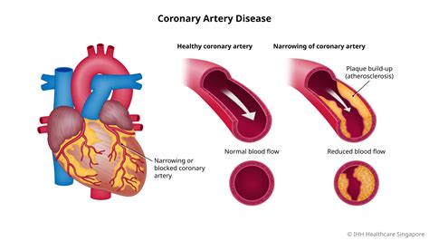Coronary Artery Disease Cad Symptoms And Causes Parkway Shenton