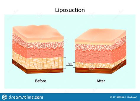 Liposuction The Human Skin Layer Before Lipo And After Liposuction