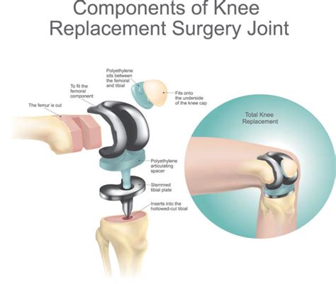 Knee Replacement Surgery Total Knee Arthroplasty Schulze Orthopedics