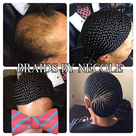 This condition is known as traction alopecia. incredible! | Alopecia hairstyles
