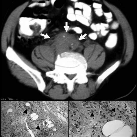 Fig Abdominal Ct Scan Without Contrast Showing Retroperitoneal Soft
