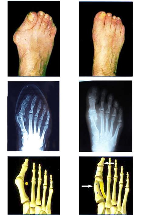 Op Ration Chirugicale D Un Hallux Valgus