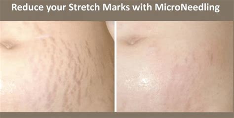 Microneedling For Stretch Marks Beauty Revival By Samantha Hill