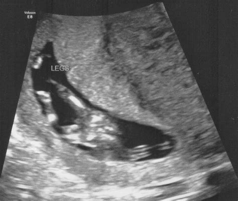 The Lion And The Lambes Baby 3 12 Week Nt Scan