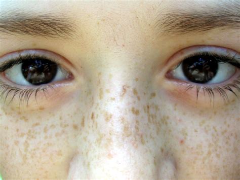 This Is The Cause Of Black Spots On Face You Need To Know Health On