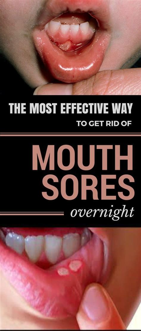The Most Effective Way To Get Rid Of Mouth Sores Overnight