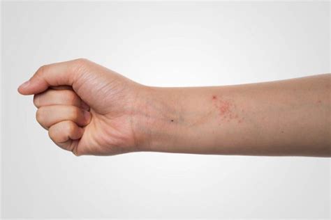 Eczema Causas Tipos Síntomas Y Tratamiento La Guía De Las Vitaminas