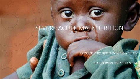 Severe Acute Malnutrition Ppt