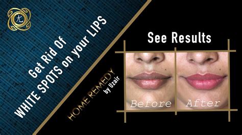 White Spots On Lips Home Remedy