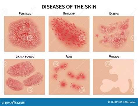 Malattie Della Pelle Infezione Eczema E Psoriasi Di Derma