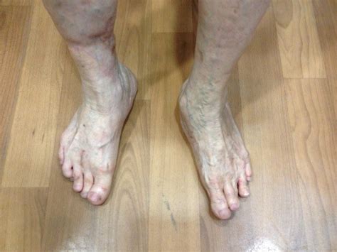 Foot Deformities Singaporesurgery Reconstructioncorrection