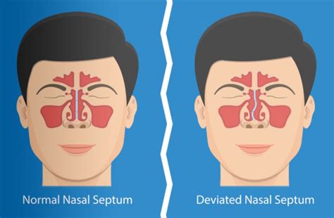 How To Fix A Deviated Septum Without Surgery Mixyfix