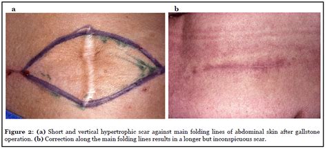 Clinical And Histological Proof That Surgical Incisions Along Skin