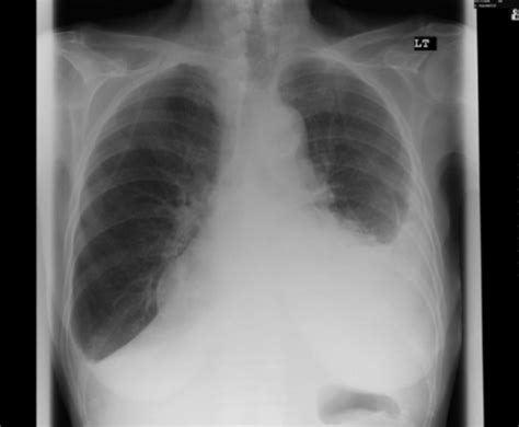 Pleural Effusion Concise Medical Knowledge