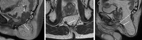 Mri Images Of Two Patients After Perineal Hernia Repair A Sagittal