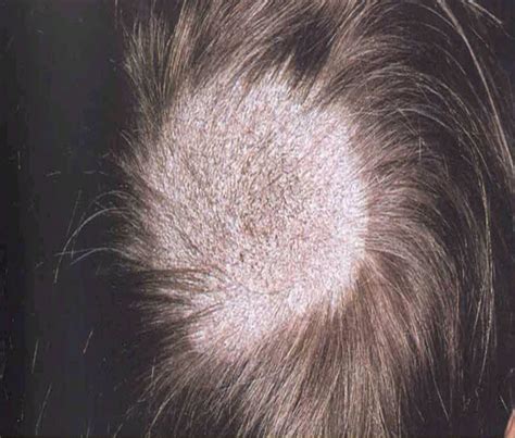 Scalp Conditions Adc Education And Practice Edition