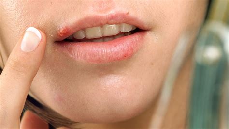 Allergic Reaction On Lips