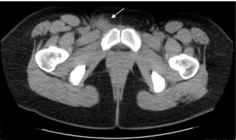 Surgical Management Of Inguinal Endometriosis Case Report And Surgical