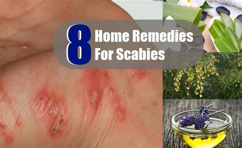 8 Home Remedies For Scabies Search Home Remedy