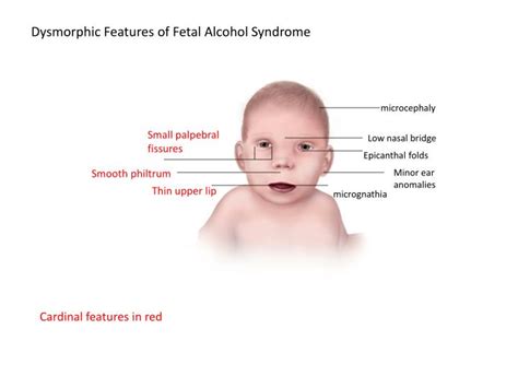 Epicanthal folds are defined as a condition in which skin of upper eyelid show skin folds towards inner corner of eye. PPT - Dysmorphic Features of Fetal Alcohol Syndrome ...