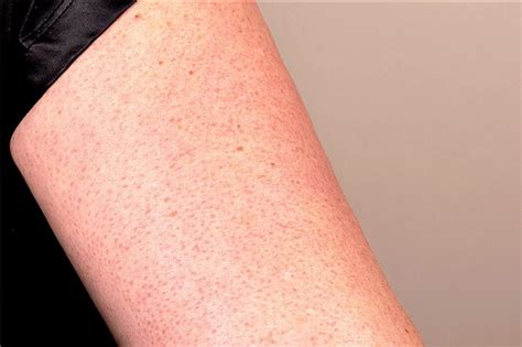 Ever Wonder Why You Get Those Weird Little Red Bumps On Your Arms