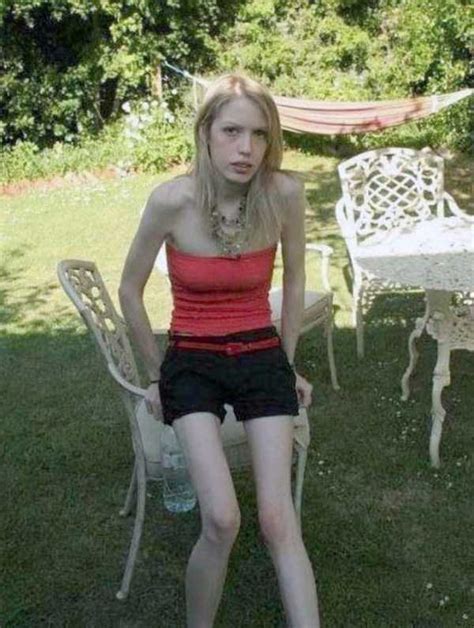 30 Shocking Pics Of Anorexic Girls KLYKER COM