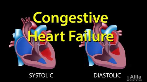 Congestive Heart Failure Left Sided Vs Right Sided Systolic Vs