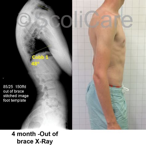 Graphic 3b Results 1 Scoliosis Clinic Uk Treating Scoliosis Without Surgery