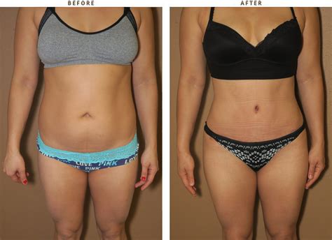 Cirugía Anti michelines Abdominoplastia Fotos Antes y Después Dr