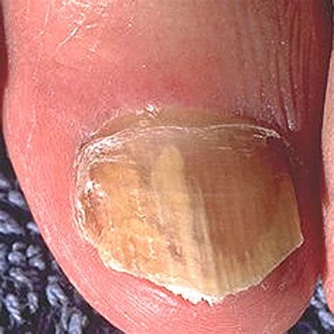 Skin Infection Pictures Toenail Fungus Remedies Fungus Treatment