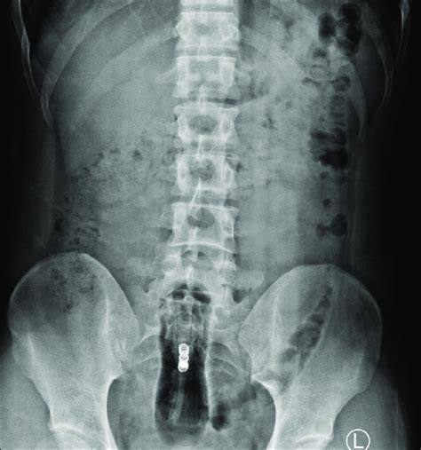 pelvic radiograph revealed a well defined radiolucent foreign body in download scientific