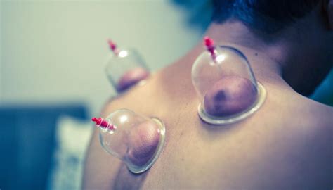 The Dangers Of Cupping And How To Avoid Them Newshub