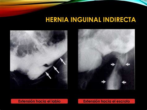 Hernia Inguinal Imagenologia