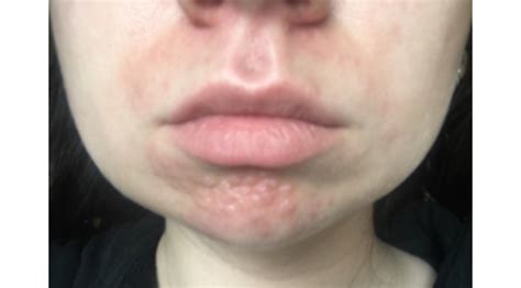 Help With Cystic Acne Bumps Hypertrophic Raised Scars