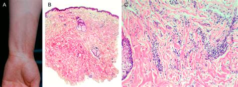 Diffuse Granuloma Annulare A Clinical Picture B Histologically A