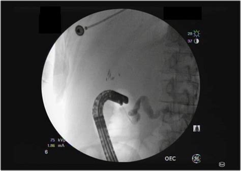 Case Report Of Pancreas Divisum And Main Duct Intraductal Papillary