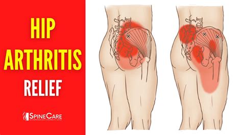 How To Relieve Hip Arthritis Pain In 30 Seconds Youtube